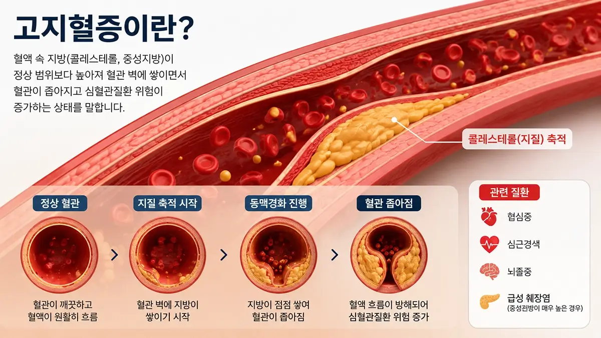 고지혈증으로 인해 혈관 벽에 콜레스테롤이 쌓이는 모습