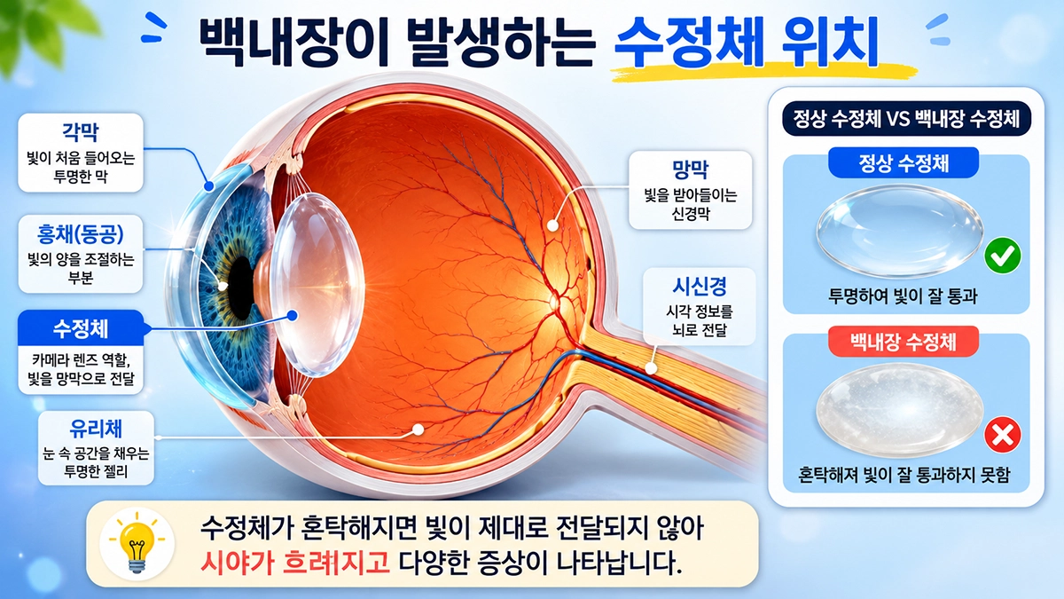백내장이 발생하는 수정체 위치