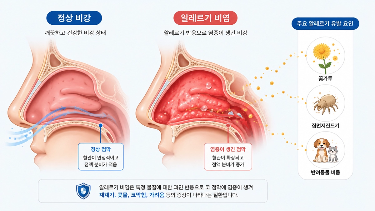 알레르기 비염으로 코 점막에 염증이 생기는 모습을 설명한 일러스트