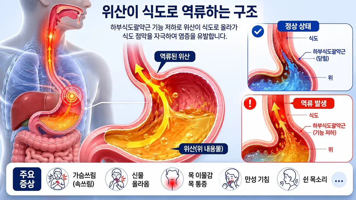 위산이 식도로 역류하는 위식도 역류질환 구조