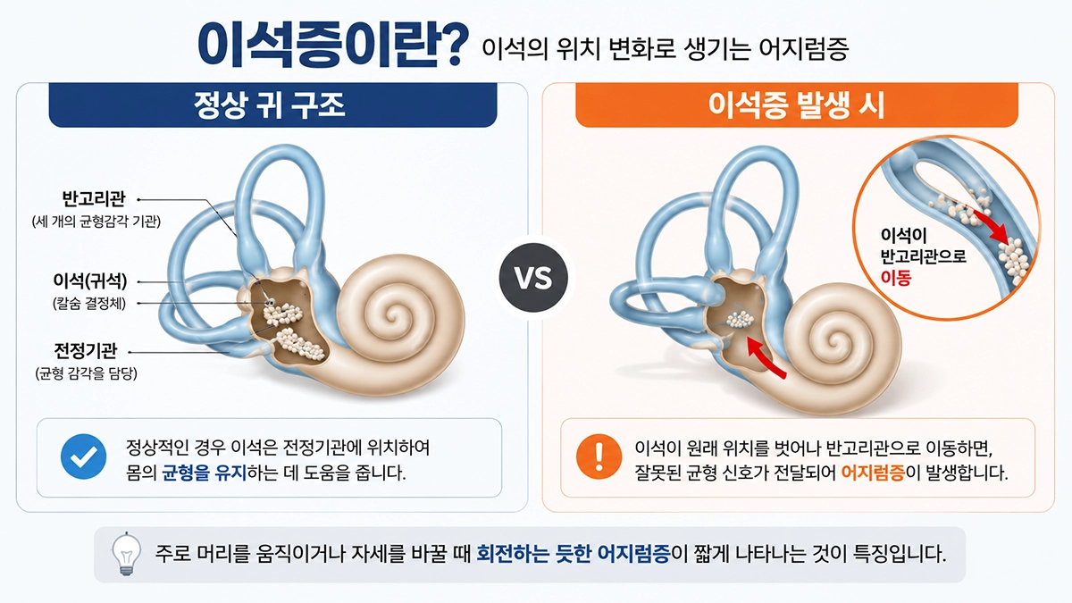 귀 전정기관과 이석 이동 구조 설명