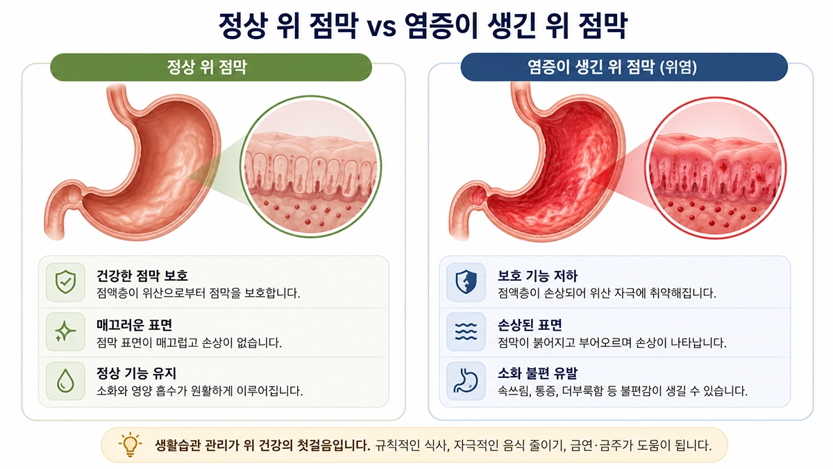 정상 위 점막과 염증이 생긴 위 점막을 비교한 설명 이미지
