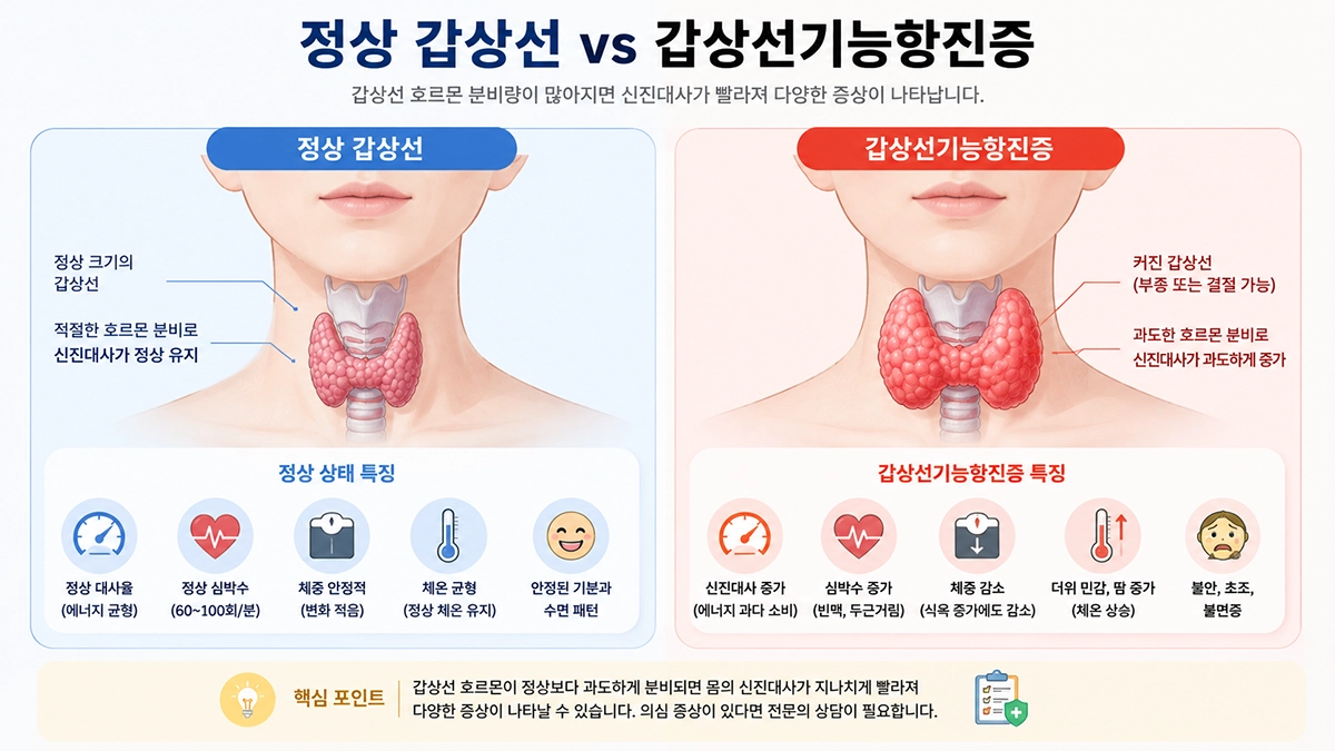 정상 갑상선과 갑상선기능항진증 상태 비교 이미지