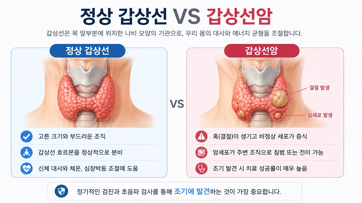 정상 갑상선과 갑상선암 비교 이미지