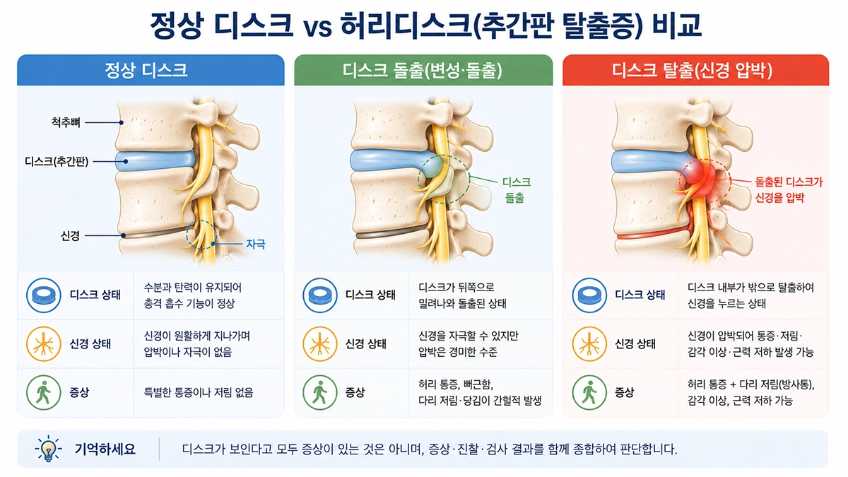정상 디스크와 허리디스크 차이를 비교한 요추 추간판 구조 이미지