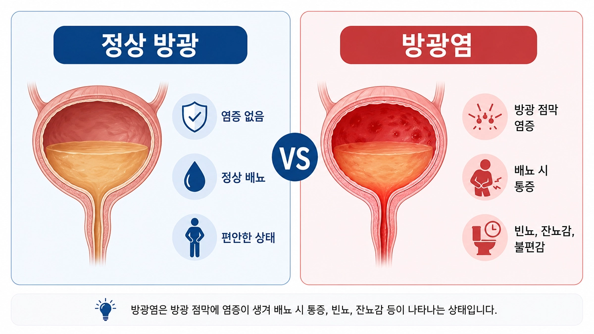 정상 방광과 방광염 방광 비교 이미지