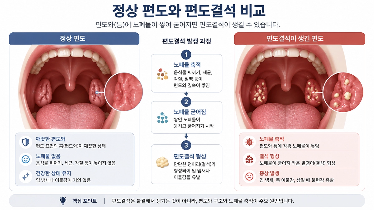 정상 편도와 편도결석이 생긴 편도 비교 이미지