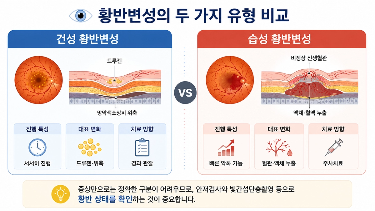황반변성의 건성과 습성 차이 및 진행 양상과 치료 방향을 비교한 이미지