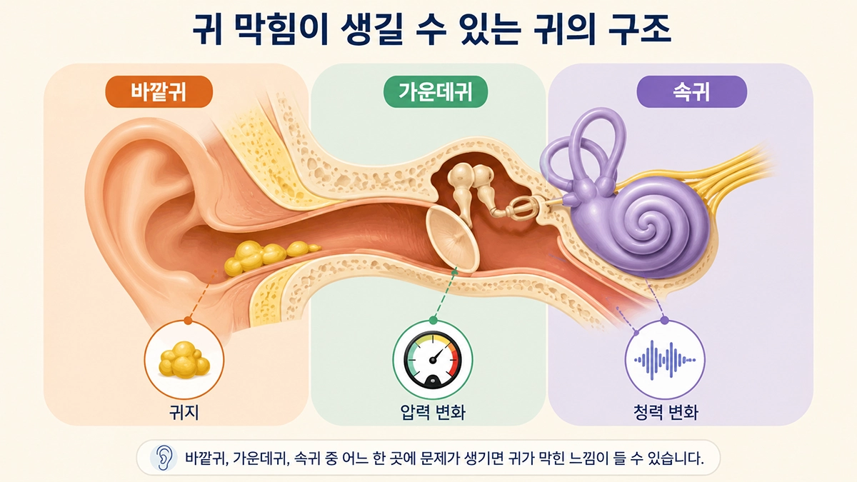 귀 막힘이 나타날 수 있는 바깥귀와 가운데귀, 속귀 구조를 설명한 인포그래픽