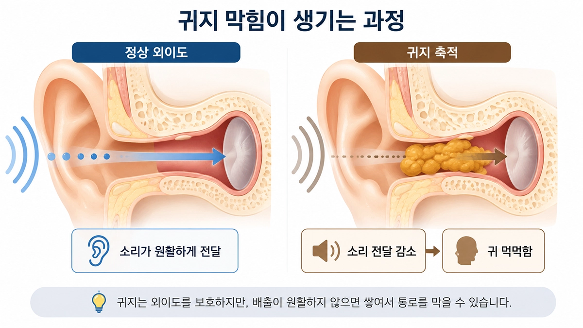 귀지 막힘으로 외이도 통로가 좁아지고 소리 전달이 감소하는 과정