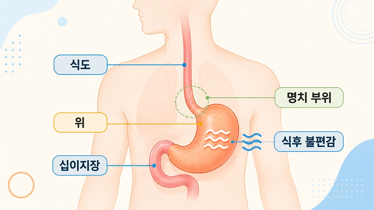 기능성 소화불량과 관련된 위 위치와 명치 부위를 보여주는 소화기관 그림