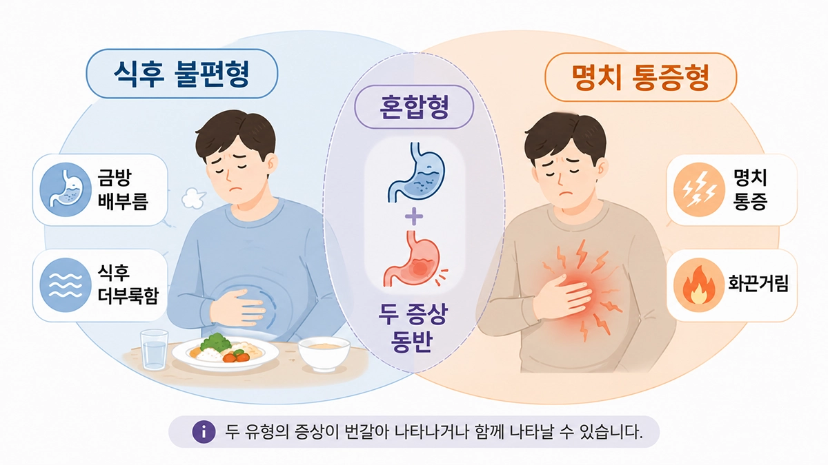 기능성 소화불량의 식후불편형과 명치통증형 차이를 비교한 인포그래픽