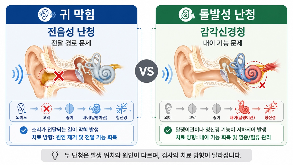 돌발성 난청과 귀지 또는 중이염으로 인한 전음성 난청의 차이를 비교한 인포그래픽