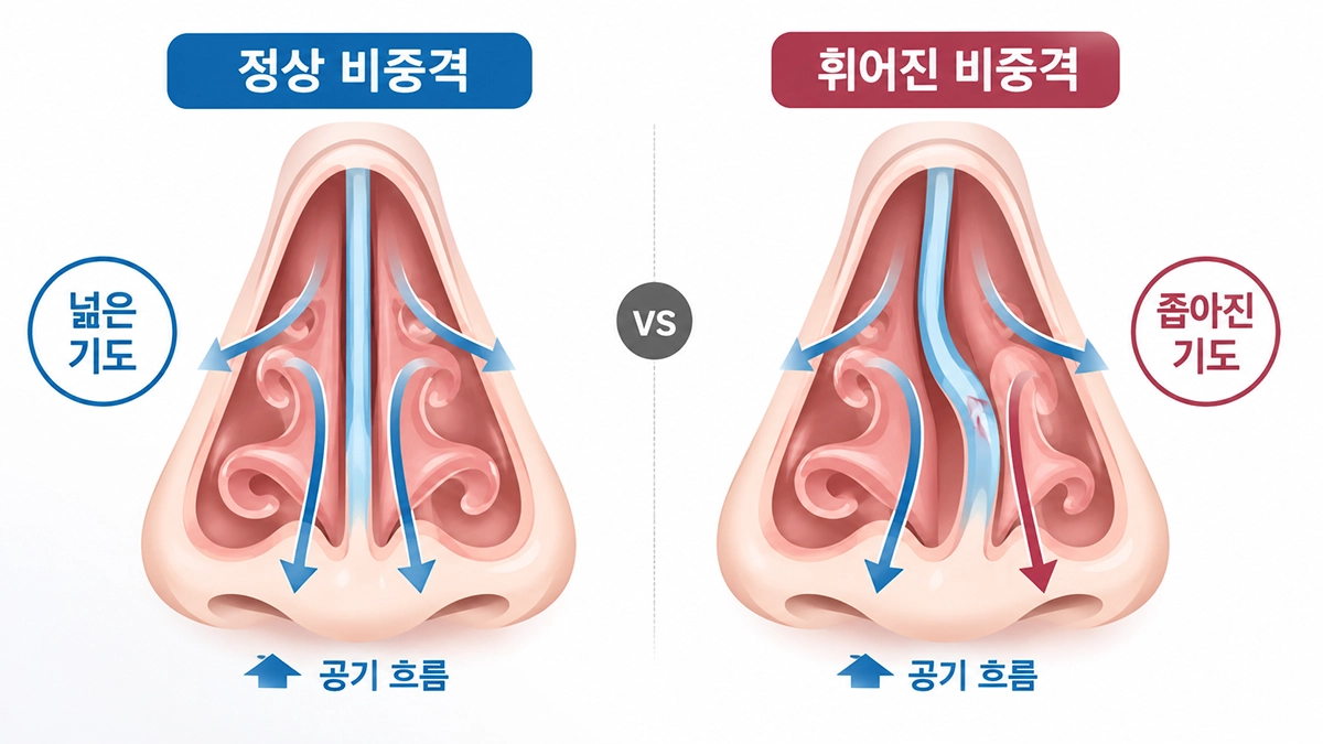 비중격만곡증으로 한쪽 콧속 공간이 좁아진 구조와 정상 비중격 비교
