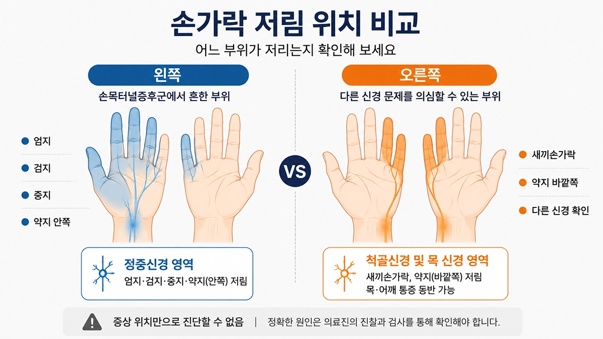 손목터널증후군 증상 위치인 엄지 검지 중지와 새끼손가락 저림 차이를 비교한 이미지
