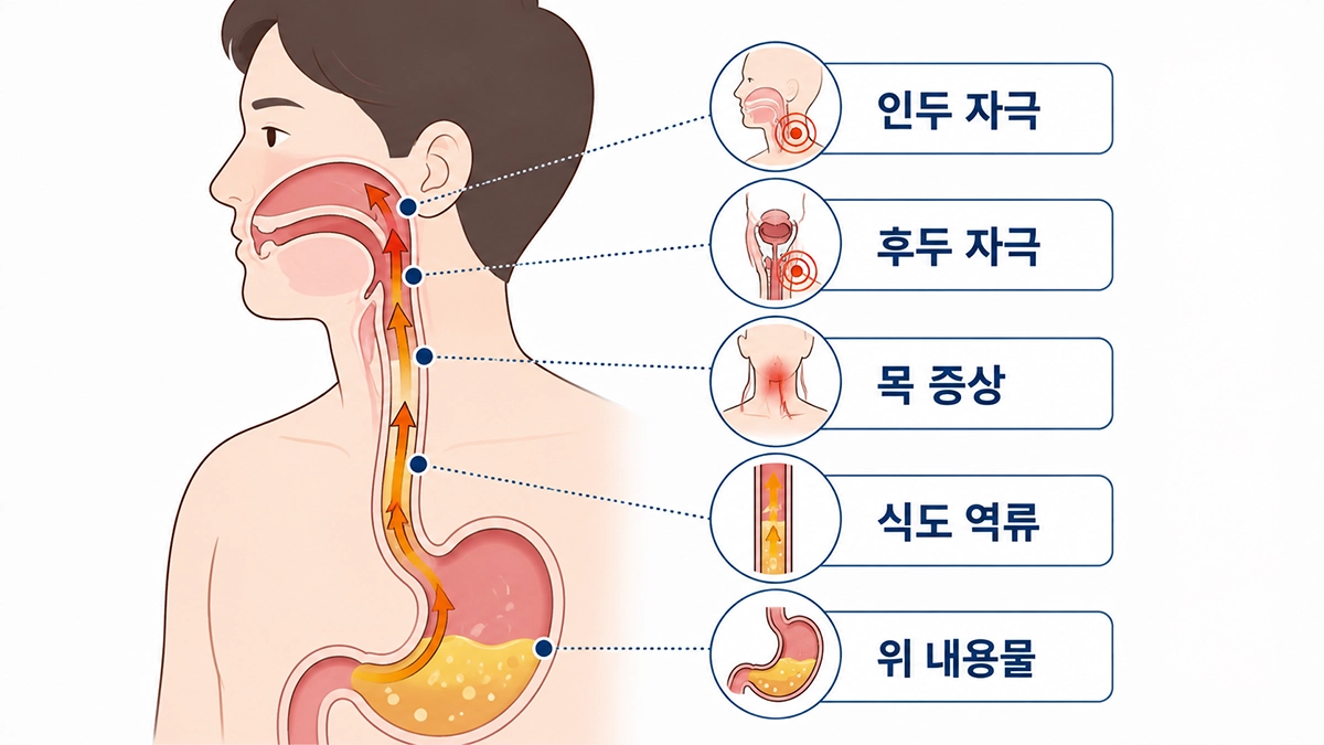 역류성 후두염에서 위 내용물이 식도를 지나 인두와 후두를 자극하는 과정