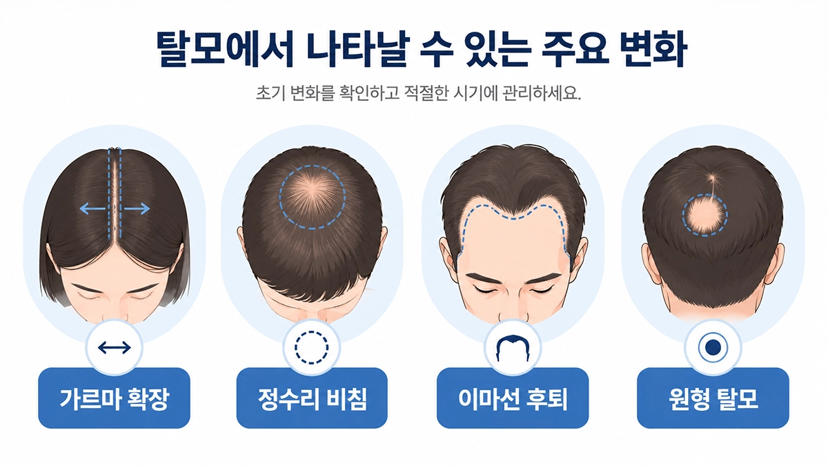 탈모에서 나타날 수 있는 가르마 확장과 정수리 비침, 이마선 후퇴를 보여주는 인포그래픽
