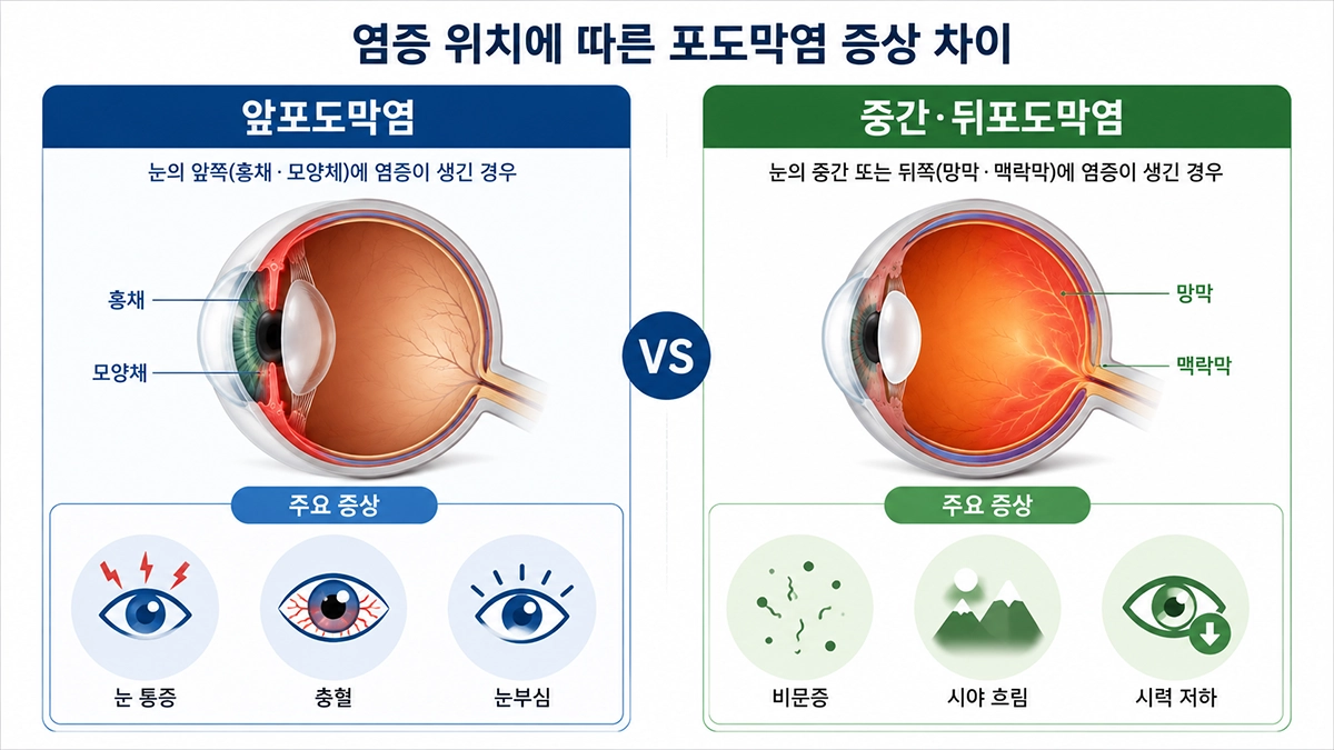 포도막염 증상을 앞포도막염과 중간·뒤포도막염으로 비교한 인포그래픽