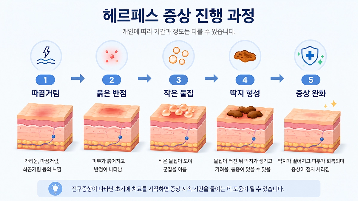 헤르페스 증상이 따끔거림부터 물집과 딱지 형성으로 진행되는 과정