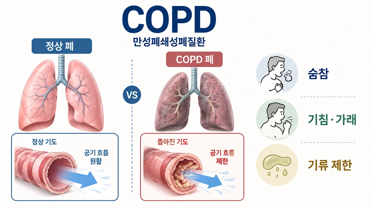 COPD에서 기도가 좁아지고 숨참과 기침·가래가 나타나는 모습을 설명한 인포그래픽
