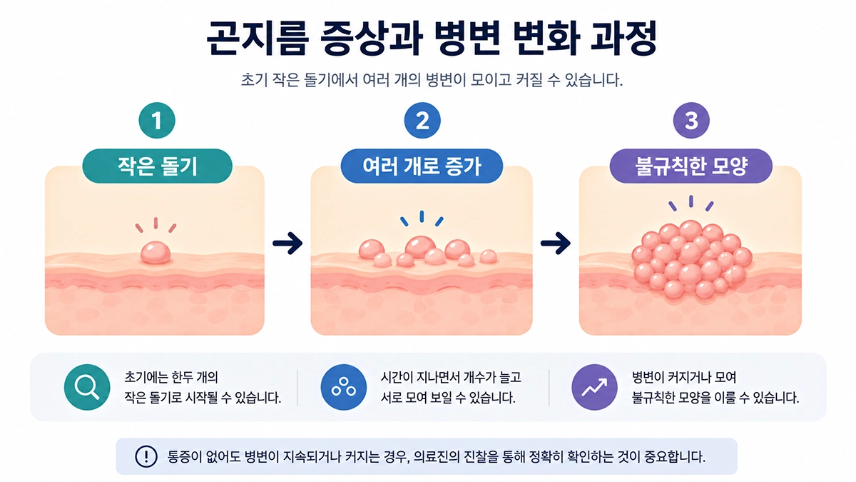 곤지름 초기 증상부터 여러 개의 돌기로 커질 수 있는 변화를 보여주는 단계형 인포그래픽