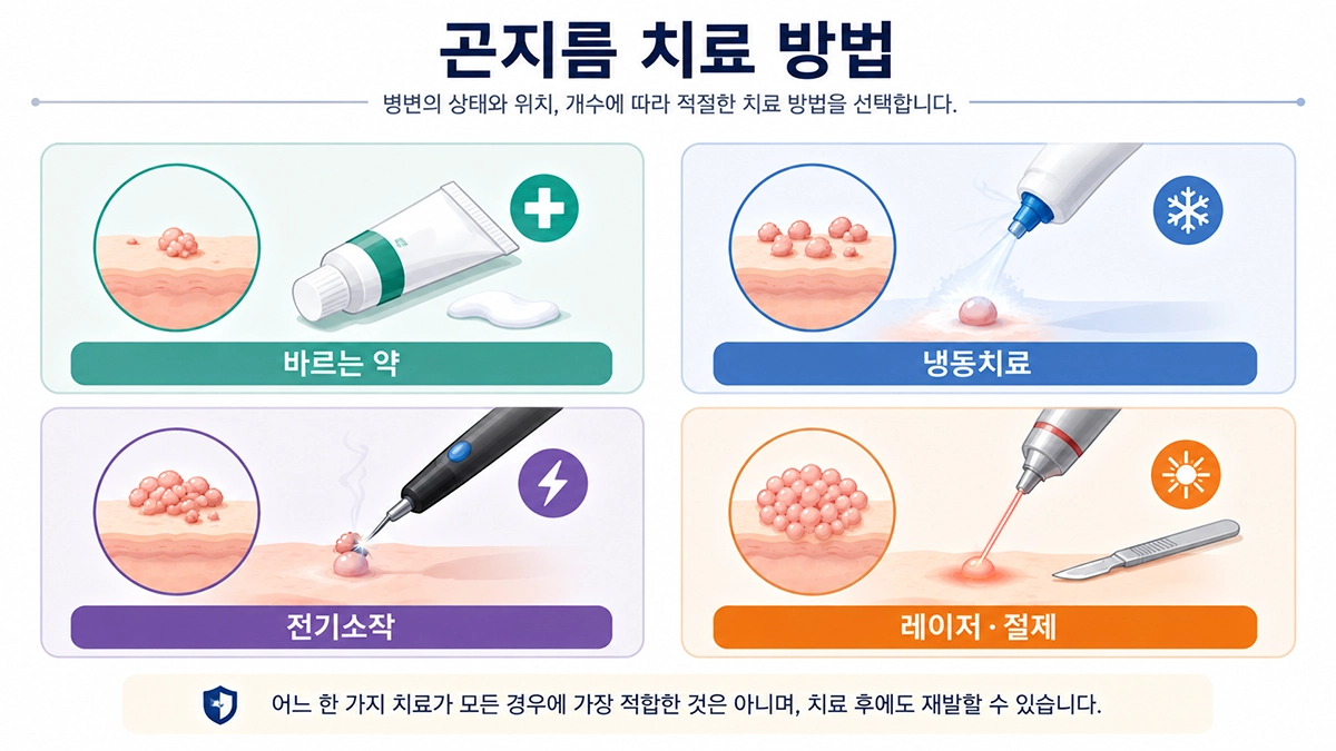 곤지름 치료에 사용되는 국소 약물 냉동치료 전기소작 레이저 절제 방법을 정리한 인포그래픽
