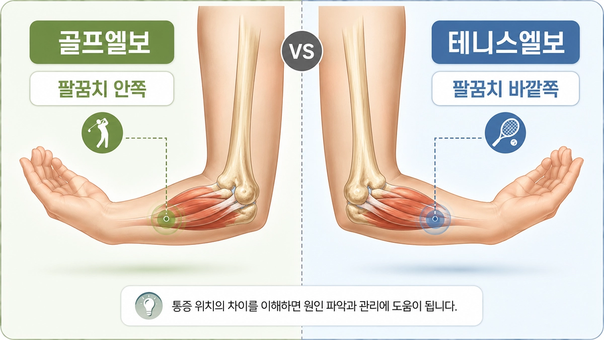 골프엘보와 테니스엘보의 팔꿈치 안쪽과 바깥쪽 통증 위치 비교