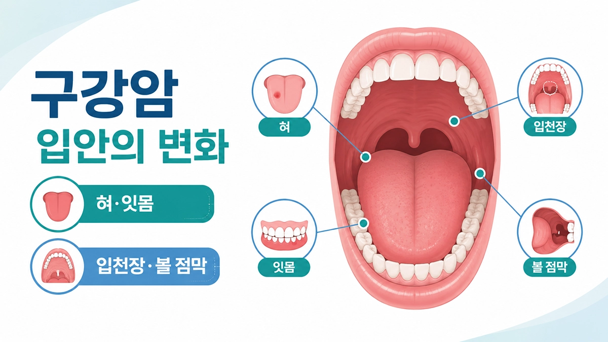 구강암 초기증상과 혀·잇몸·입천장 등 주요 발생 부위를 보여주는 인포그래픽