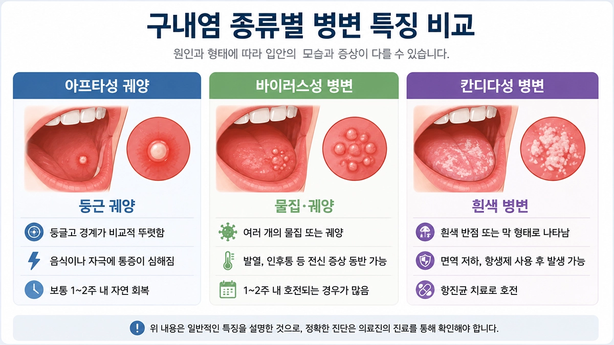 구내염 종류에 따라 나타날 수 있는 아프타성 궤양과 바이러스성·칸디다성 병변 비교