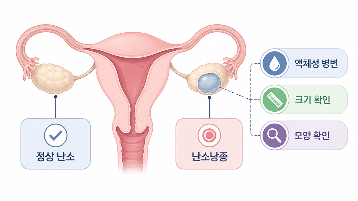 난소낭종이 난소에 생긴 위치와 정상 난소를 비교한 의료 인포그래픽