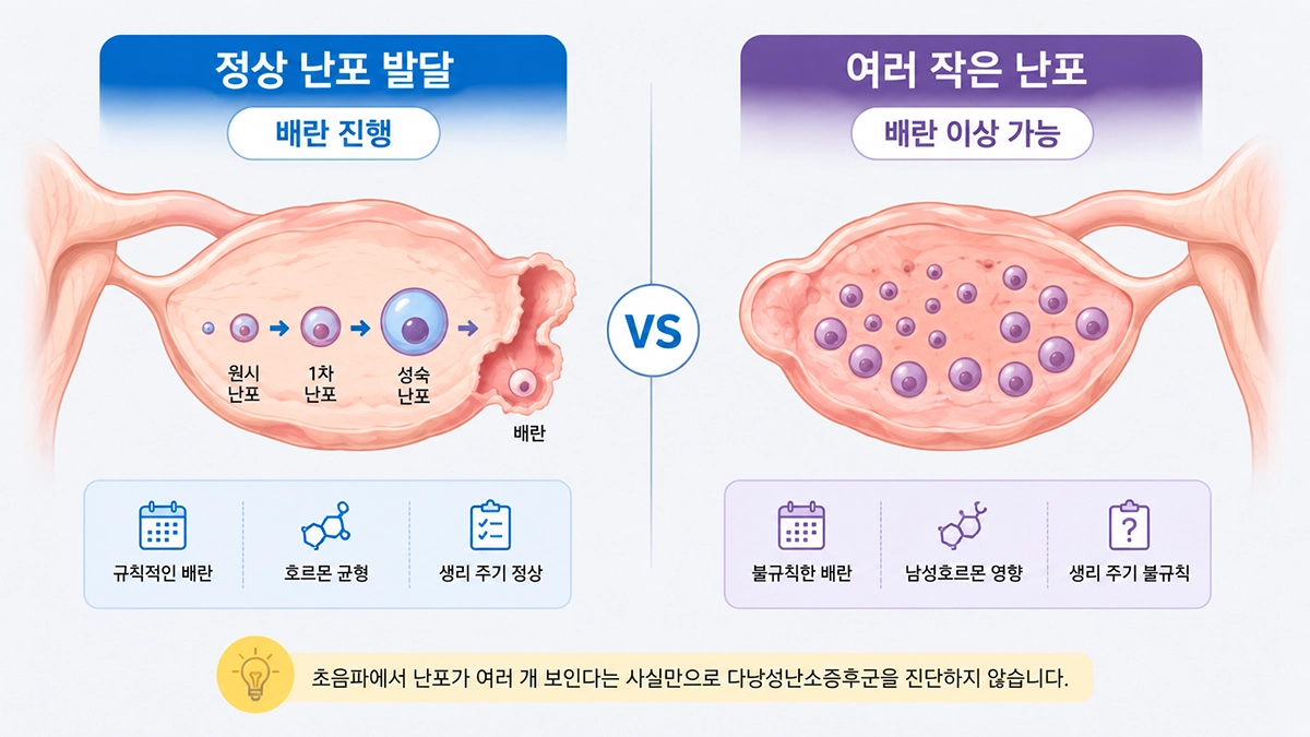 다낭성난소증후군의 난포 형태와 일반적인 난포 발달 과정을 비교한 의료 인포그래픽