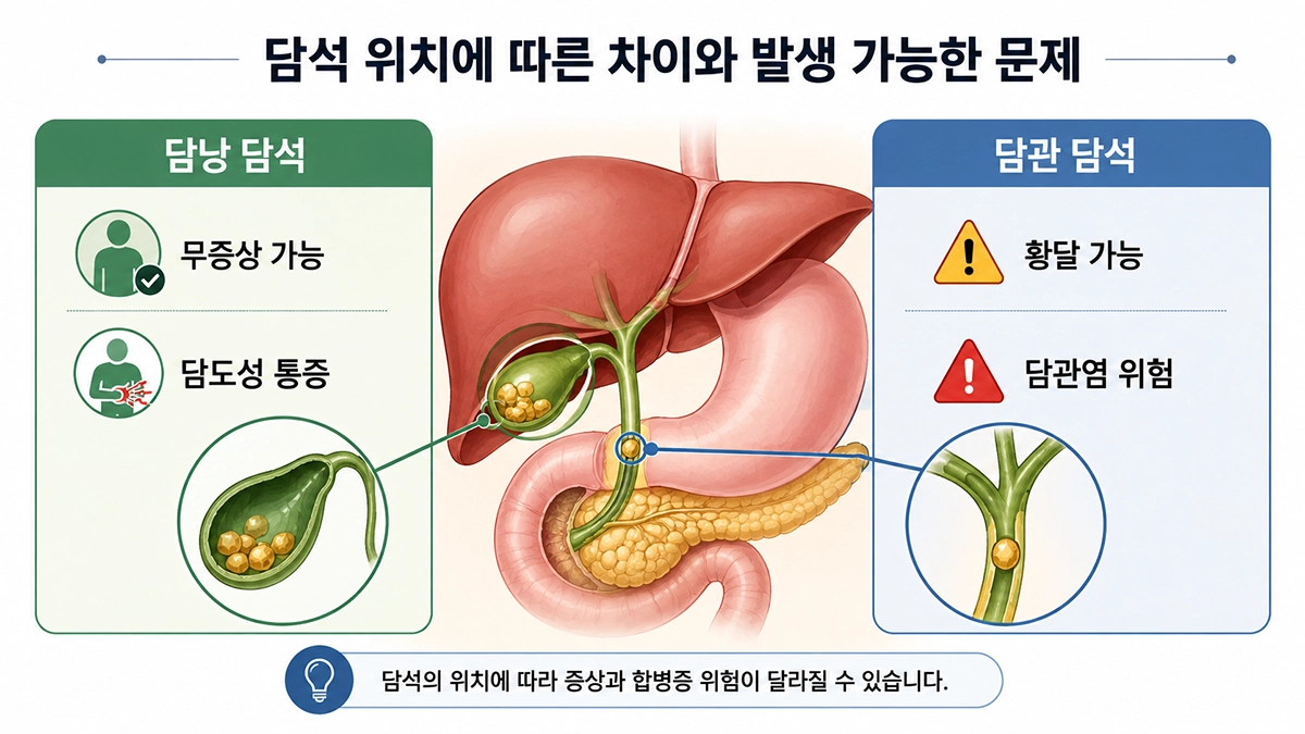 담석증 증상과 합병증 차이를 보여주는 담낭 담석과 담관 담석 비교