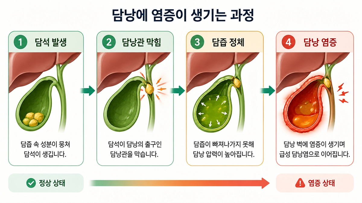 담낭염이 담석으로 담낭관이 막힌 뒤 발생하는 과정을 설명한 단계별 인포그래픽