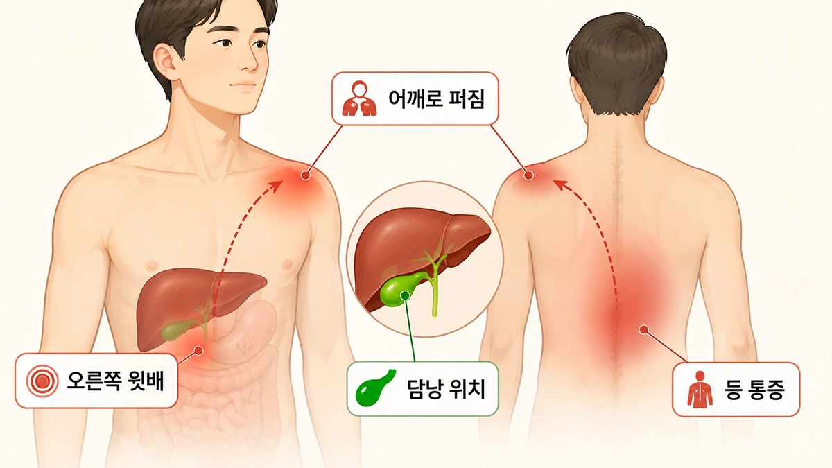 담낭염 통증이 나타나는 오른쪽 윗배와 어깨·등으로 퍼지는 부위를 설명한 그림