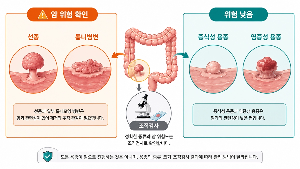 대장용종 종류별 암 관련성과 조직검사 필요성을 비교한 인포그래픽
