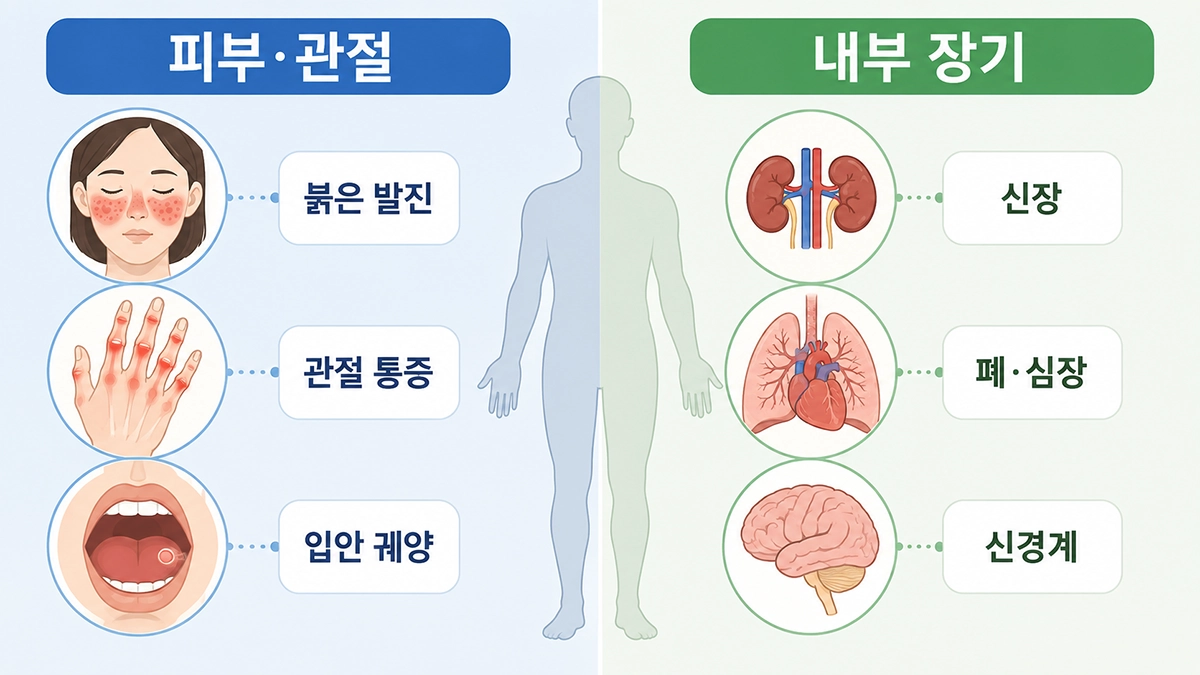 루푸스 증상이 피부와 관절 및 신장·폐·심장 등에서 나타날 수 있음을 비교한 인포그래픽
