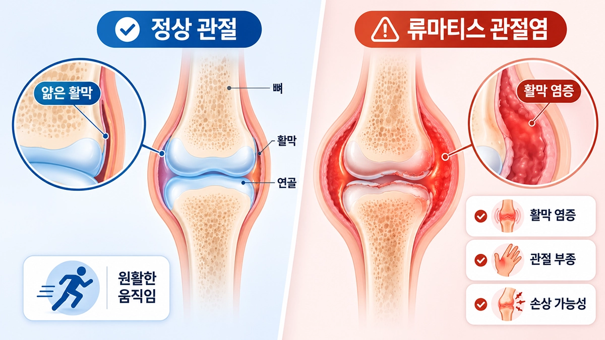 류마티스 관절염의 활막 염증과 정상 관절의 차이를 비교한 관절 구조 이미지
