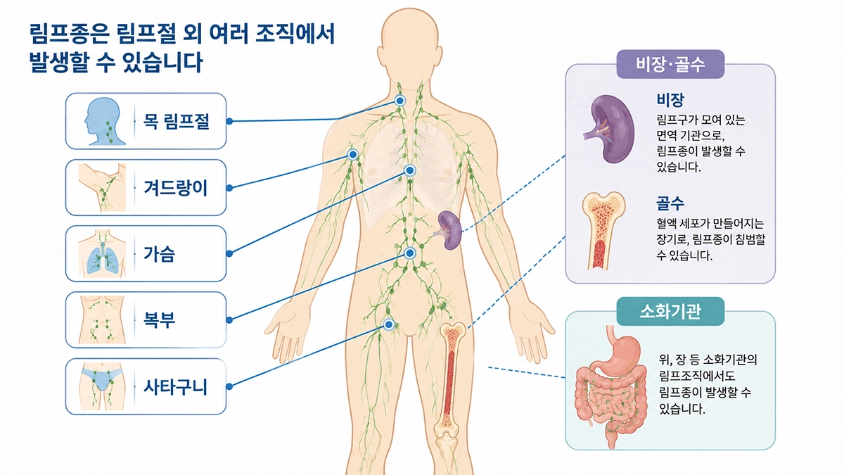 림프종 증상과 관련해 목과 겨드랑이, 사타구니 등 주요 림프절과 비장·골수 위치를 보여주는 그림
