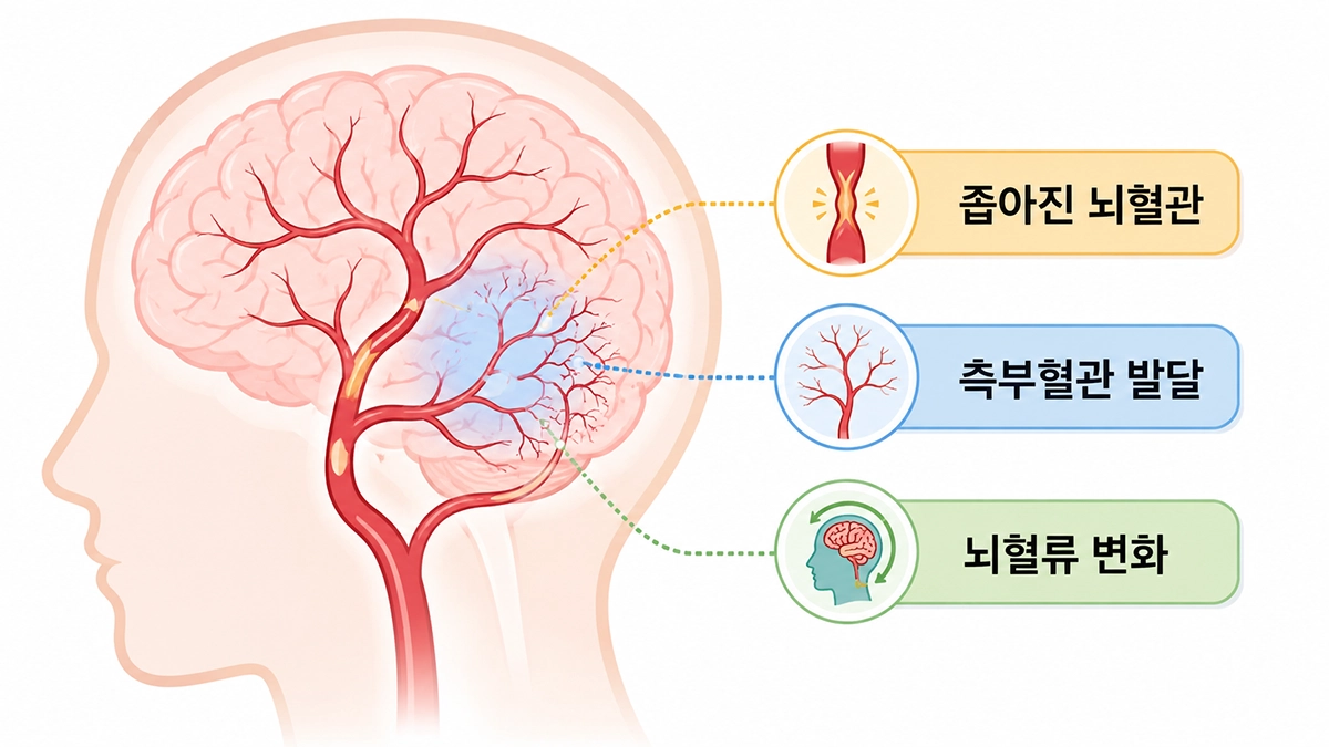 모야모야병에서 좁아진 뇌혈관과 측부혈관 발달을 설명하는 그림