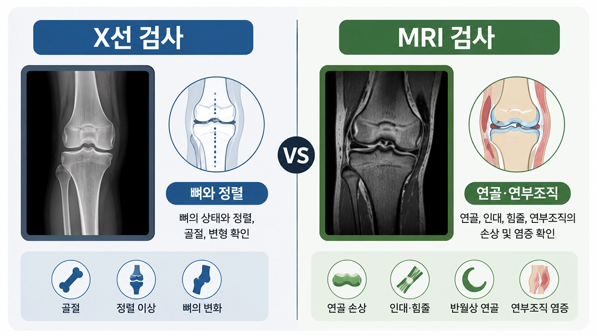 무릎연골연화증 검사에서 X선과 MRI가 확인하는 내용을 비교한 인포그래픽
