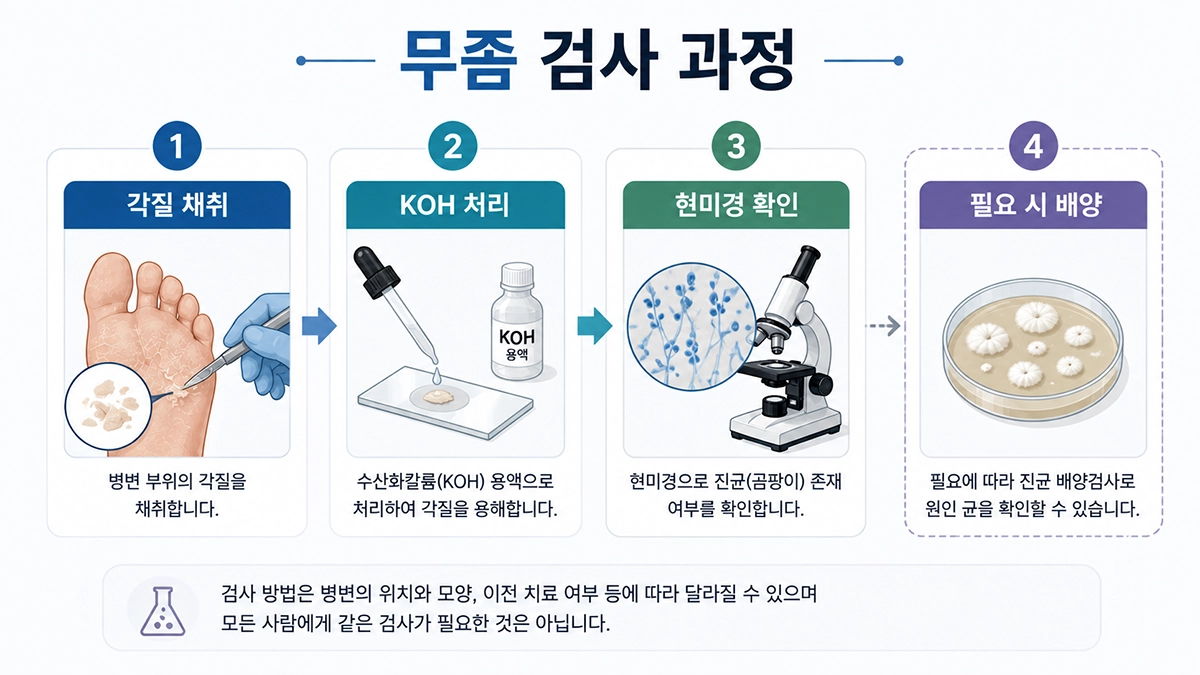 무좀 진단에서 각질 채취와 KOH 현미경 검사를 설명하는 단계형 인포그래픽