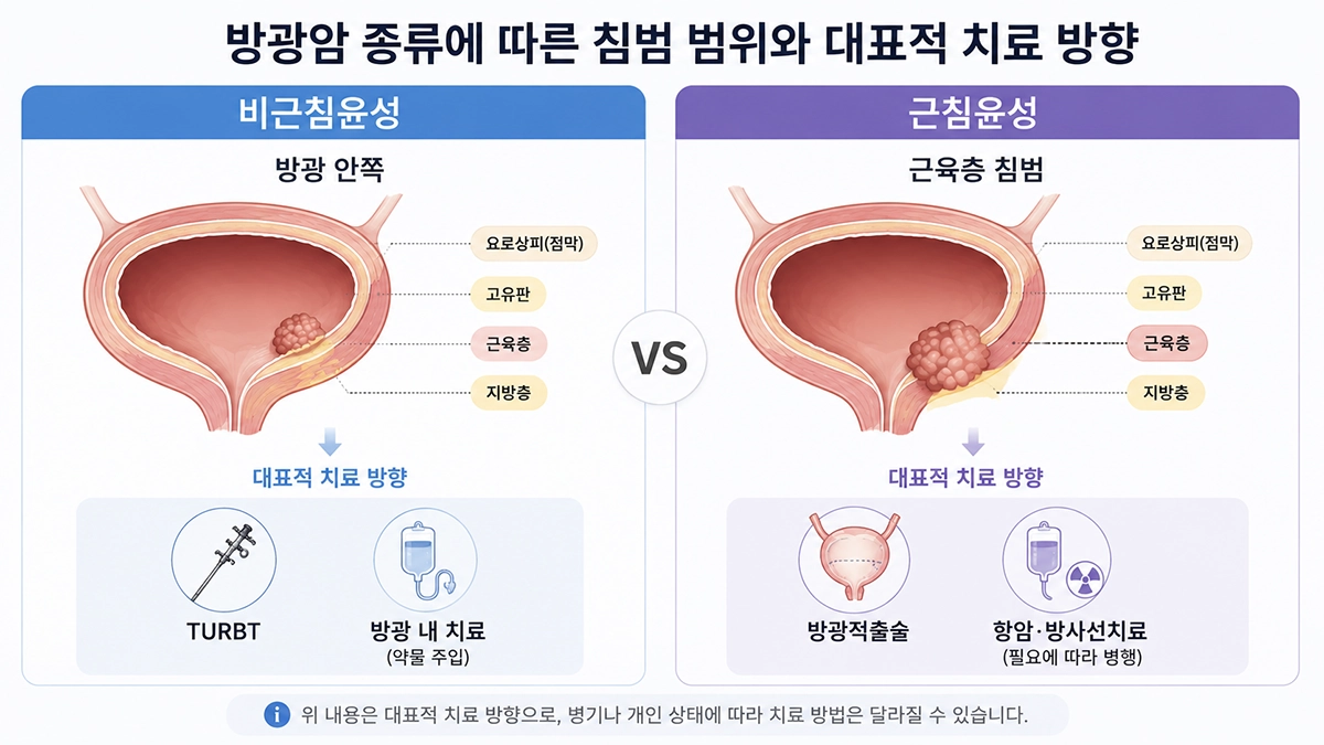 방광암 초기증상 이후 진단되는 비근침윤성 방광암과 근침윤성 방광암의 치료 방향 비교