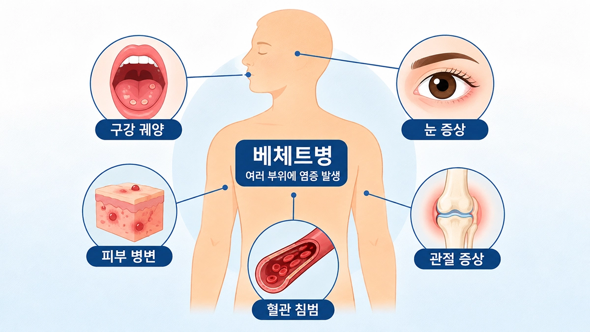 베체트병에서 나타날 수 있는 구강 궤양과 피부, 눈, 관절, 혈관 증상 인포그래픽