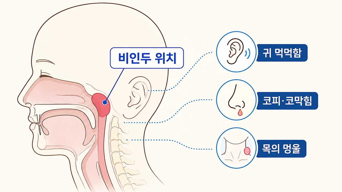 비인두암 발생 위치와 귀 먹먹함, 코피, 목 멍울 등 주요 증상을 보여주는 그림