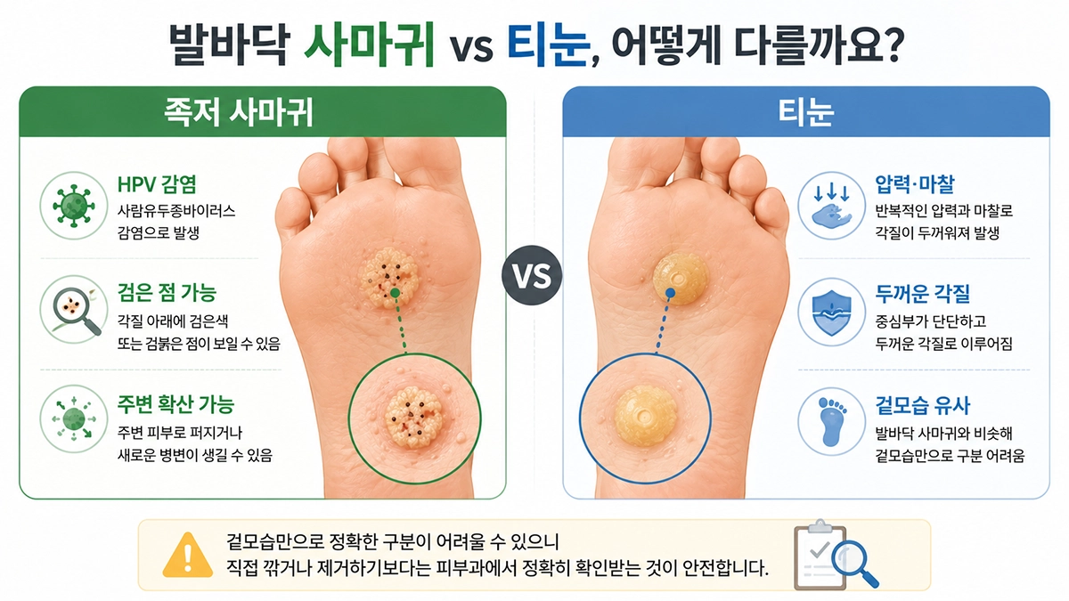 발바닥 사마귀와 티눈의 원인 및 피부 특징을 비교한 인포그래픽