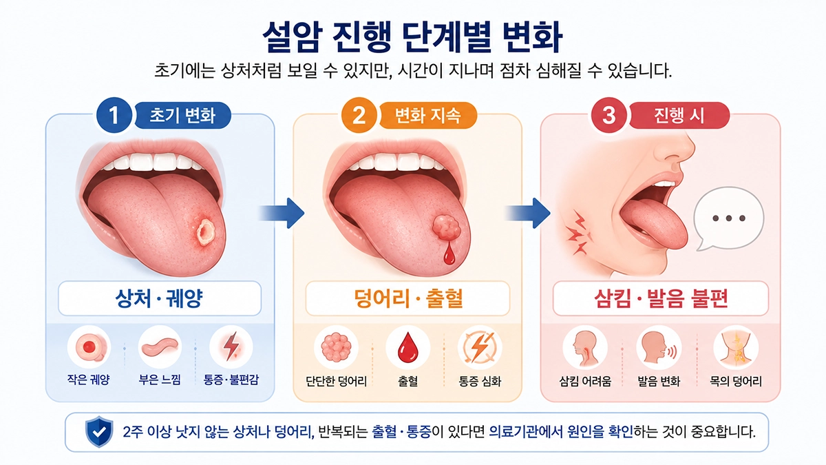 설암 초기증상부터 덩어리와 출혈, 삼킴 불편까지 나타날 수 있는 변화를 단계별로 설명한 이미지