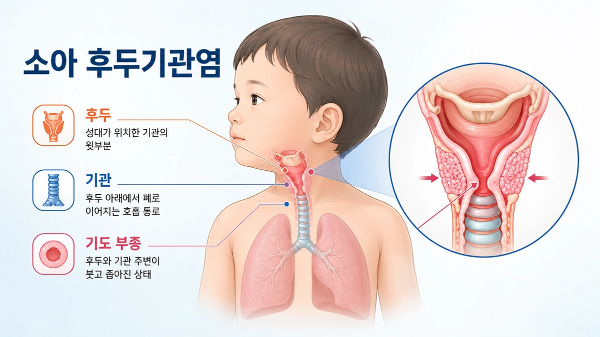 소아 후두기관염에서 후두와 기관 주변의 기도 부종 위치를 보여주는 의료 그림
