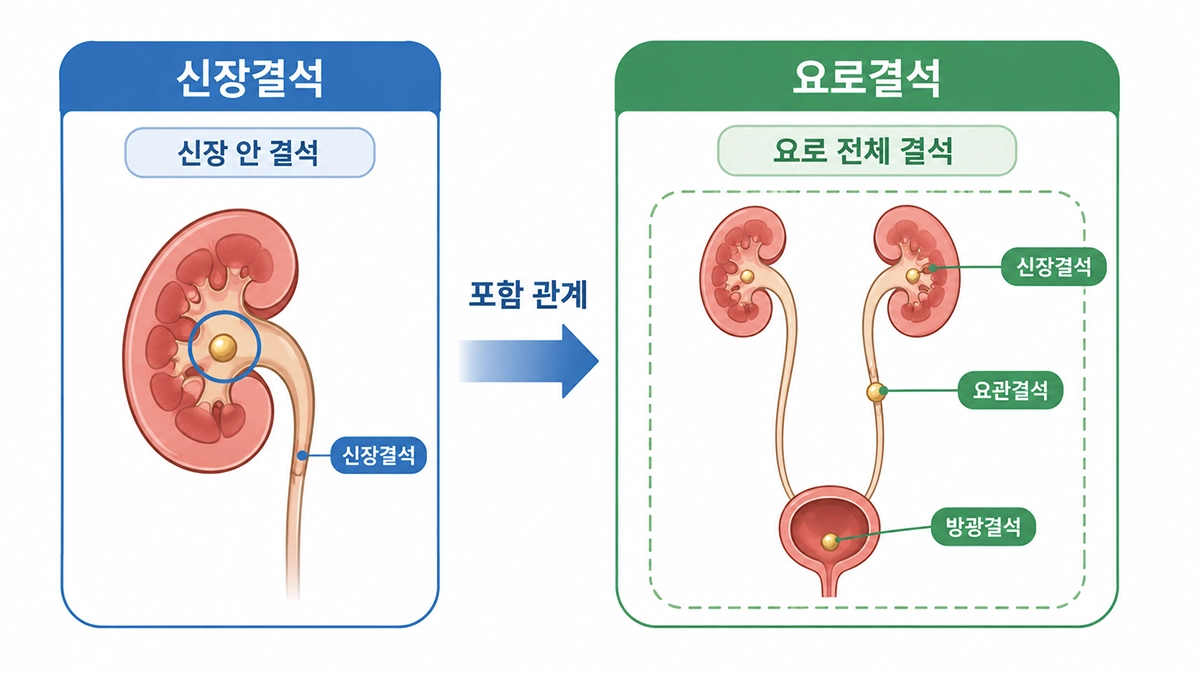 신장결석과 요로결석의 범위와 차이를 비교한 인포그래픽