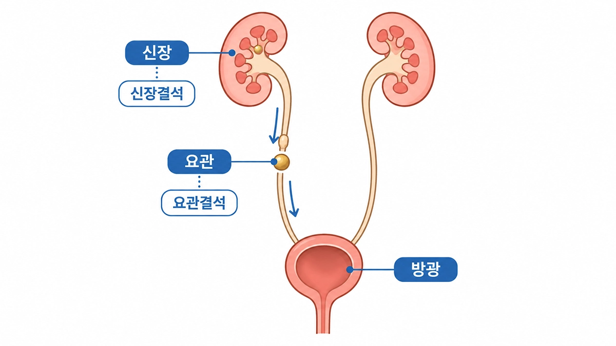 신장결석이 신장에서 요관과 방광 방향으로 이동하는 위치를 설명한 요로 구조 이미지