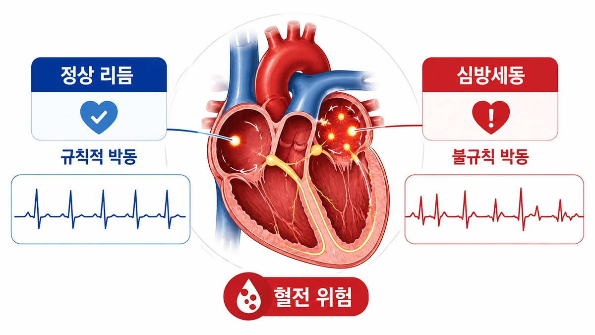 심방세동에서 나타나는 불규칙한 심장 박동과 정상 리듬의 차이